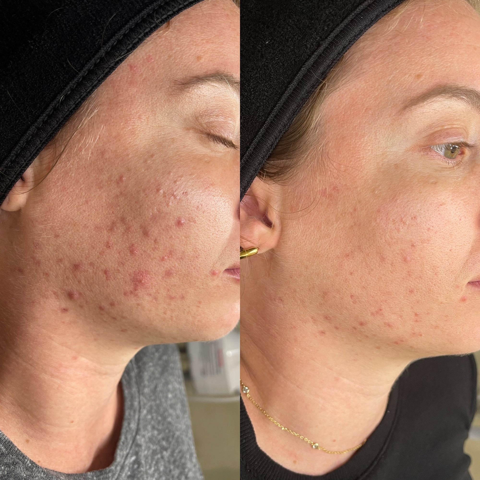 3 Chemical Peel Series Fall Special
