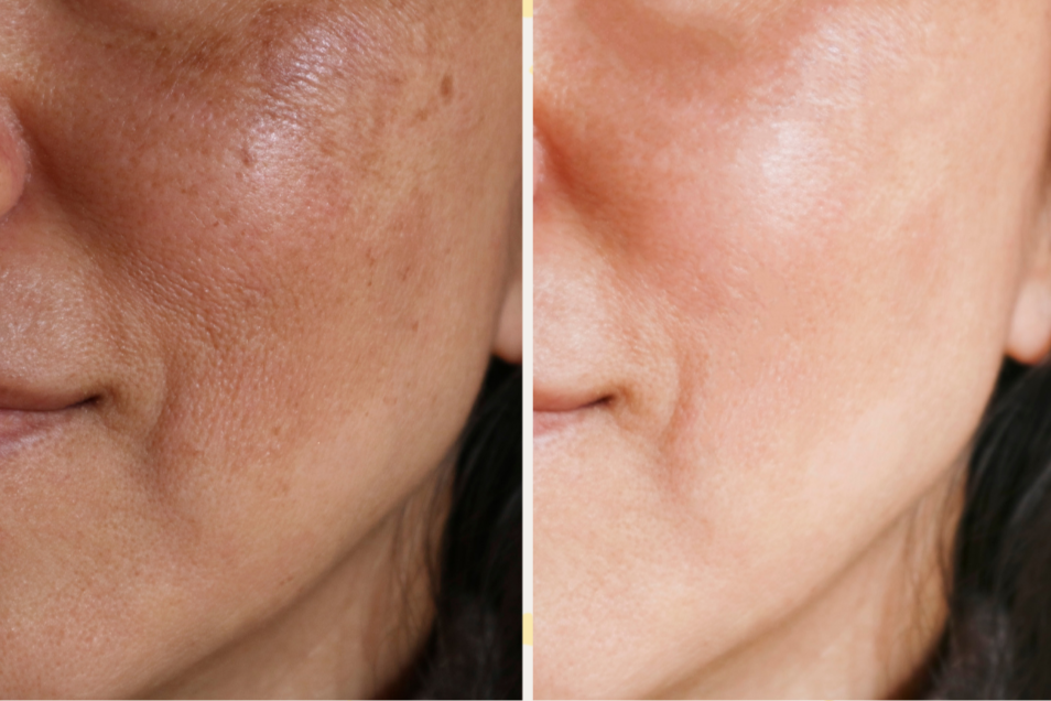 3 Chemical Peel Series Black Friday Discount